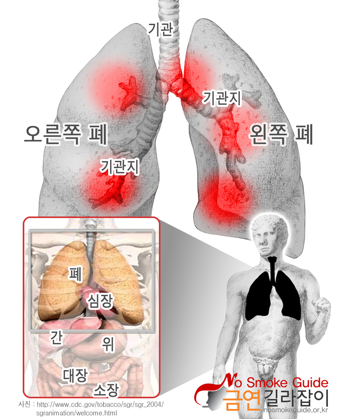 폐 이미지